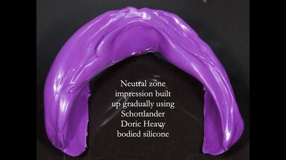 Newsletter 83: Sheila’s Complete Denture Success