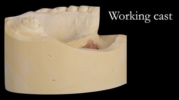Upper metal base partial denture/occlusal stabilisation splint/obturator - full protocol