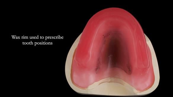 Newsletter 77: Jeremy’s case – immediate complete upper denture