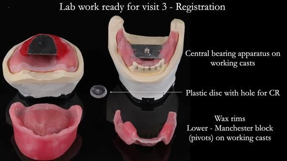 Newsletter 52 Managing Jo’s failing dentition with extractions and Mk 1/Mk 2 complete upper dentures and lower partial dentures FULL PROTOCOL