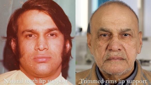 Managing poor implant positioning with complete dentures and Locator attachments - full protocol Newsletter 41