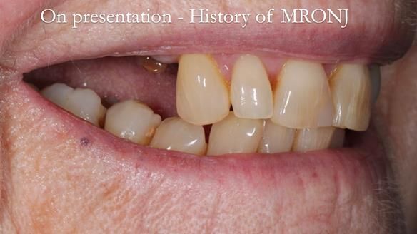 Finlay's Newsletter 60 Sylvia's upper Kennedy Class 2 Mod 1 metal based upper RPD