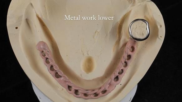Finlay's Newsletter 59 Ultra hard partial dentures made for Gill