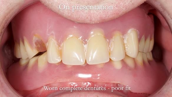 Newsletter 57 showcases the making and fitting process of implant-supported complete dentures for Alisdair