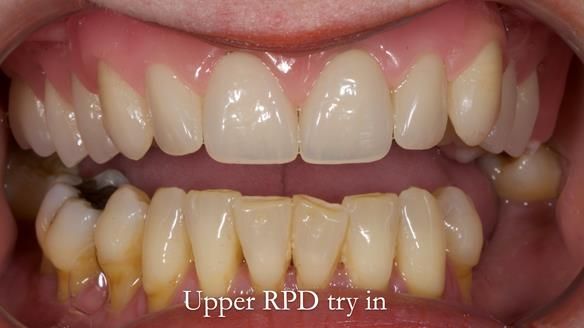 Finlay's Newsletter 58 Gasket upper partial denture for Zoe