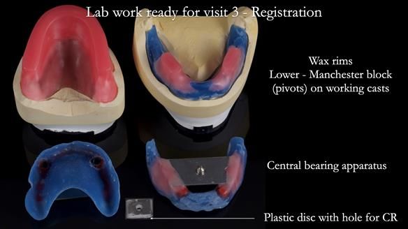 Newsletter 57 showcases the making and fitting process of implant-supported complete dentures for Alisdair