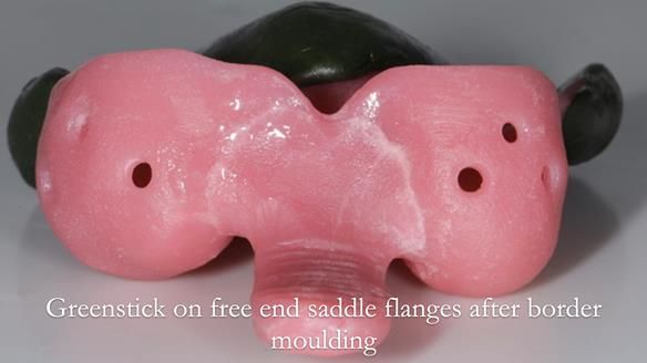 Finlay's Newsletter 59 Ultra hard partial dentures made for Gill