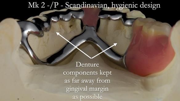 Newsletter 54 case presentation upper complete denture and lower Scandinavian designed hygienic partial denture for David