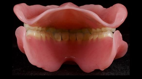 Newsletter 80 - Gordon’s dentures: the one case in 1,000 where my technique failed