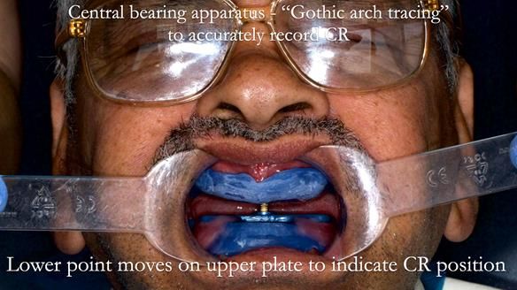 Finlay's Newsletter 62 provision of extractions and metal based complete dentures for Rafique