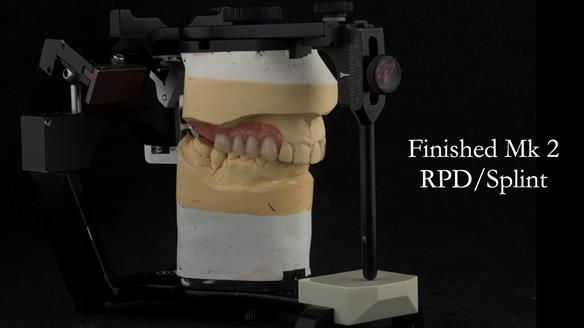 Newsletter 51 Managing Anne’s failing dentition with distal extension base RPD/Splint FULL PROTOCOL