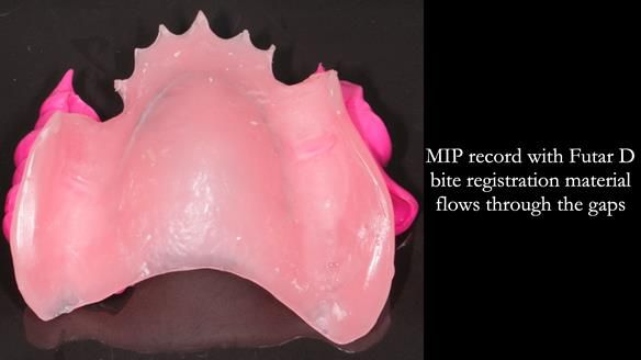 Newsletter 56 showing the making and fitting of a bilateral free end saddle upper removable partial denture (RPD) for patient with pemphigus