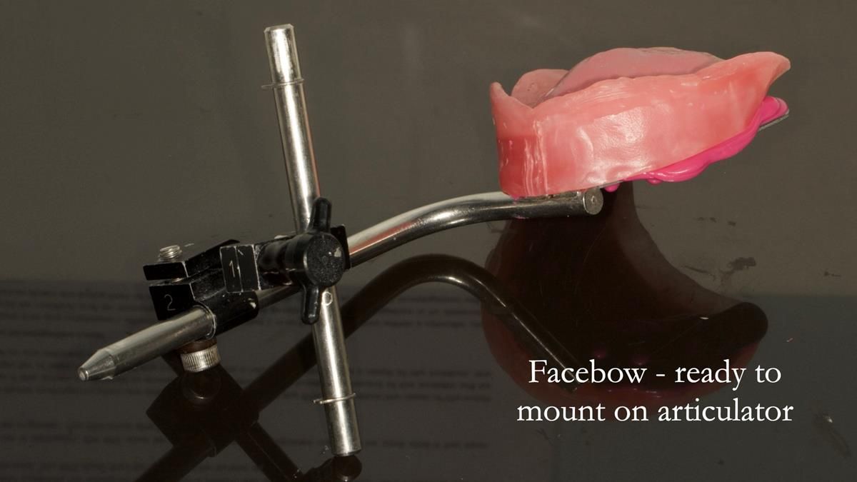 Newsletter 87 – Father Peter: A Partial Denture that needed Minor Miracle