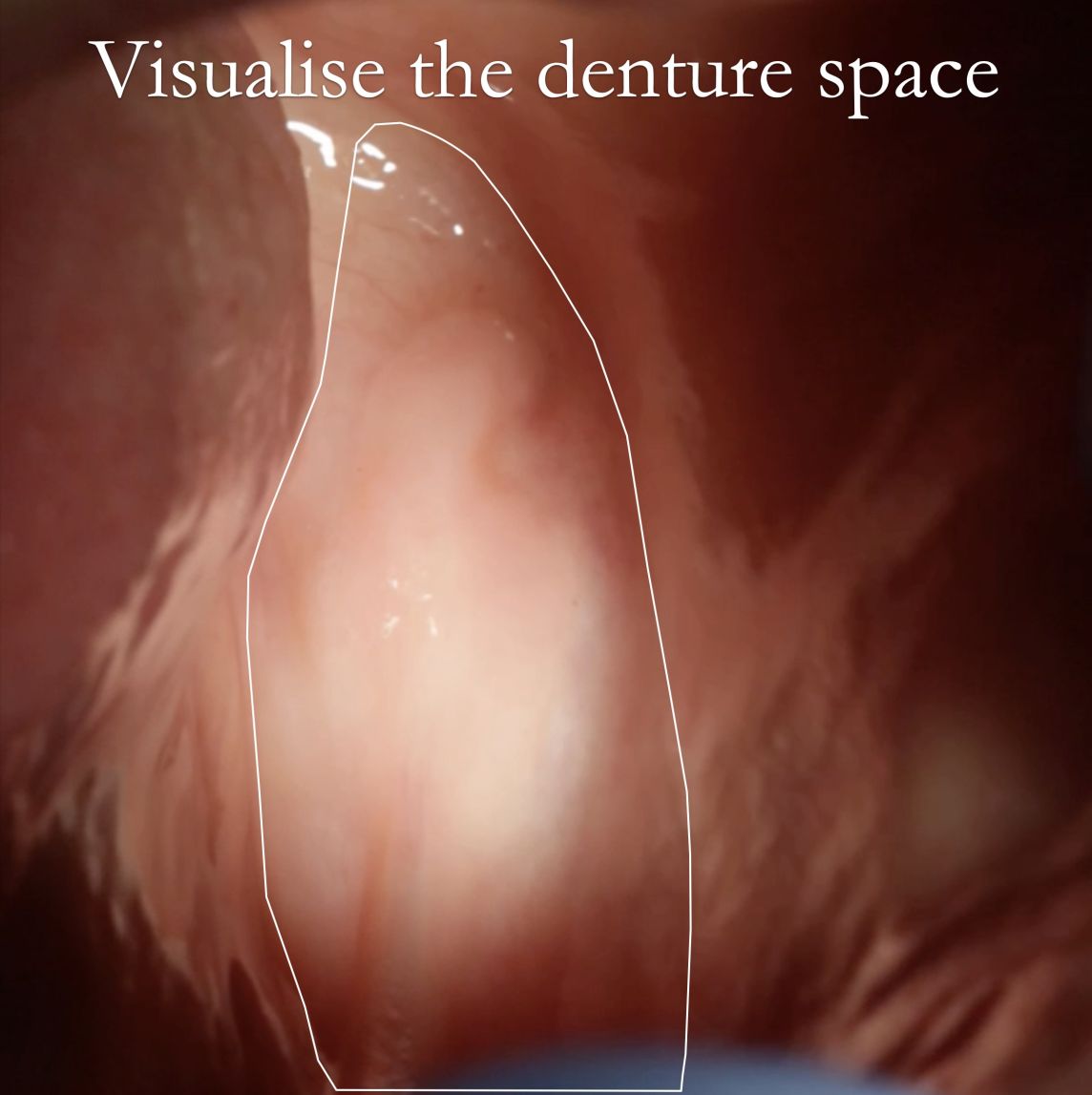 Visualise the denture space before taking primary impressions
