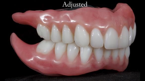 Newsletter 65 Marisa Provision of Complete Dentures on badly placed implants