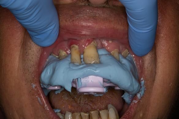 Figure 12 Maxillary stock tray impression made in alginate (Dentsply Blueprint) recording the palate, palatal and occlusal surfaces of the teeth. I didn't want to extract the teeth in the impression stage 1