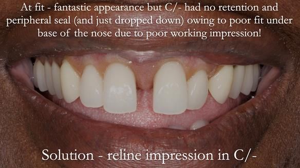 Newsletter 53 showing the making and fitting of ultra life-like dentures for Valena