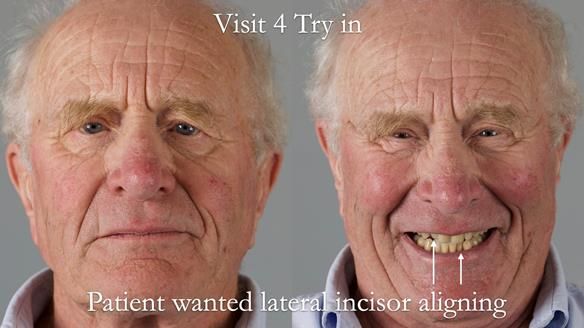 Complete denture Class II div 2 deep overbite Newsletter 39