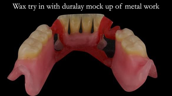 Finlay's Case Study Newsletter 40 - Immediate Mk 1 RPD to Definitive Mk 2 RPD - full protocol