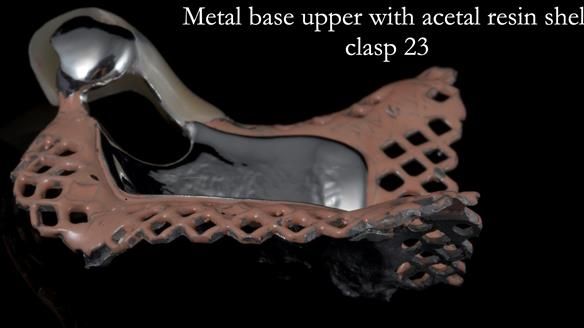 Newsletter 55 Provision of metal based partial dentures for Zephyrine with a repaired cleft lip and palate