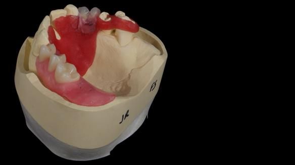 Newsletter 86 Peter the Architect — precision removable partial dentures case study