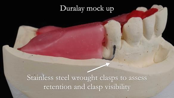 Newsletter 56 showing the making and fitting of a bilateral free end saddle upper removable partial denture (RPD) for patient with pemphigus