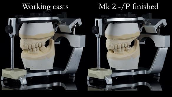 Newsletter 54 case presentation upper complete denture and lower Scandinavian designed hygienic partial denture for David