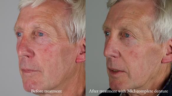 Newsletter 77: Jeremy’s case – immediate complete upper denture