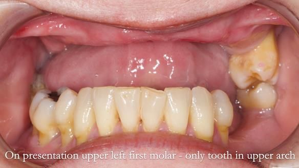 Finlay's Newsletter 58 Gasket upper partial denture for Zoe