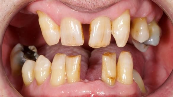 Newsletter 86 Peter the Architect — precision removable partial dentures case study