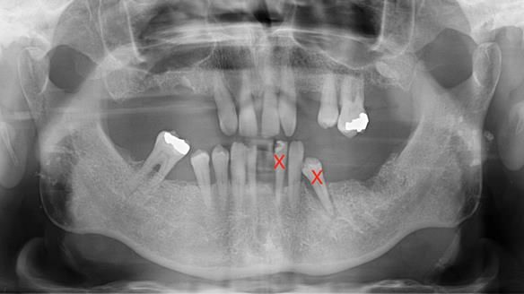 Newsletter 86 Peter the Architect — precision removable partial dentures case study