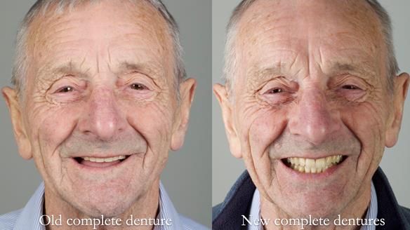 Newsletter 80 - Gordon’s dentures: the one case in 1,000 where my technique failed