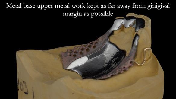 Finlay's Case Study Newsletter 40 - Immediate Mk 1 RPD to Definitive Mk 2 RPD - full protocol