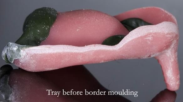 Newsletter 54 case presentation upper complete denture and lower Scandinavian designed hygienic partial denture for David