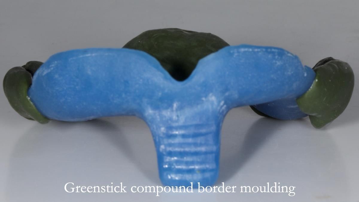 Fin’s Newsletter 88 — Complete dentures - full protocol… he rearranged his own teeth!