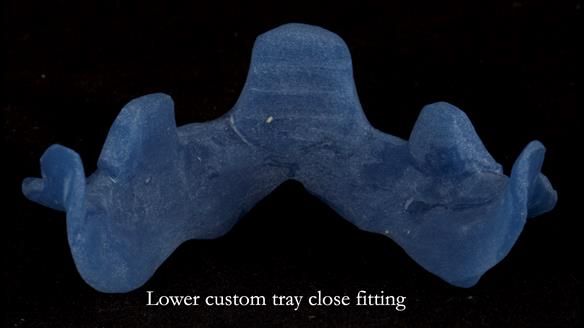 Newsletter 83: Sheila’s Complete Denture Success