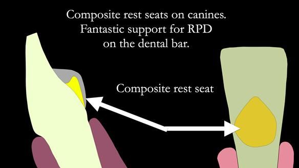 Finlay's Newsletter 61 provision of a lower unilateral free end saddle metal based partial denture for Joyce