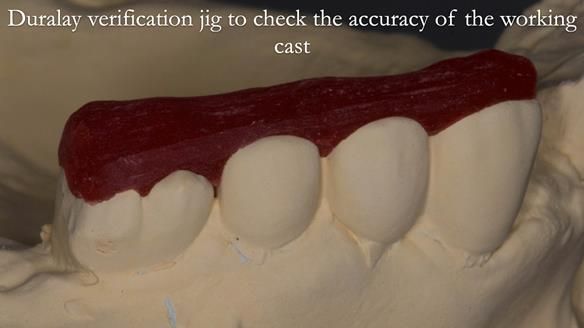 Newsletter 51 Managing Anne’s failing dentition with distal extension base RPD/Splint FULL PROTOCOL
