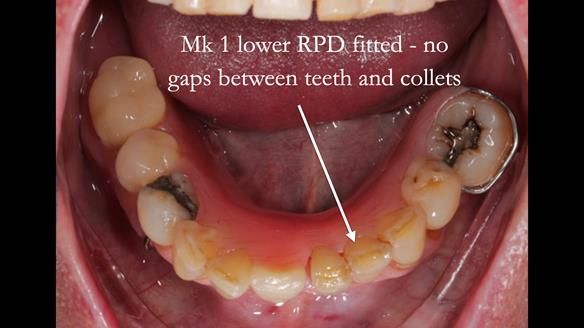 Newsletter 54 case presentation upper complete denture and lower Scandinavian designed hygienic partial denture for David