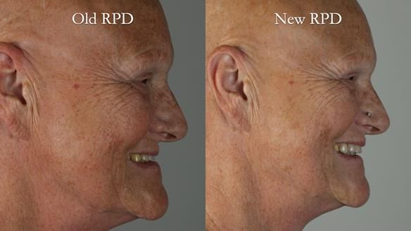 Newsletter 81 - Pam’s Story — how a partial denture changed her life (+ live walkthrough this Thursday)