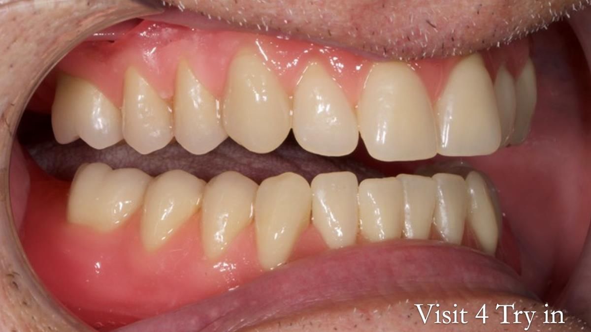 Fin’s Newsletter 88 — Complete dentures - full protocol… he rearranged his own teeth!