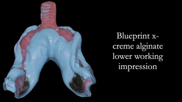 Newsletter 52 Managing Jo’s failing dentition with extractions and Mk 1/Mk 2 complete upper dentures and lower partial dentures FULL PROTOCOL