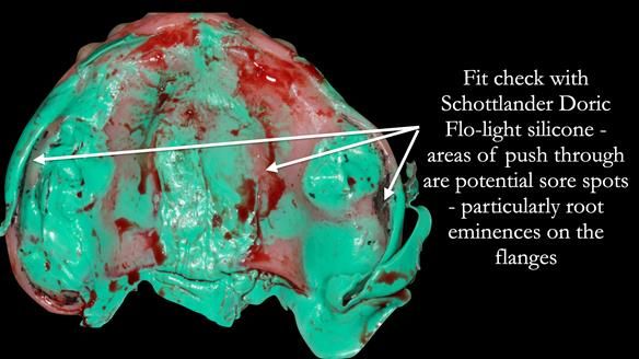 Newsletter 52 Managing Jo’s failing dentition with extractions and Mk 1/Mk 2 complete upper dentures and lower partial dentures FULL PROTOCOL
