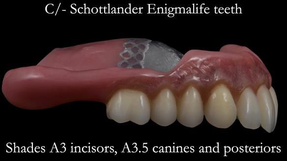 Newsletter 53 showing the making and fitting of ultra life-like dentures for Valena