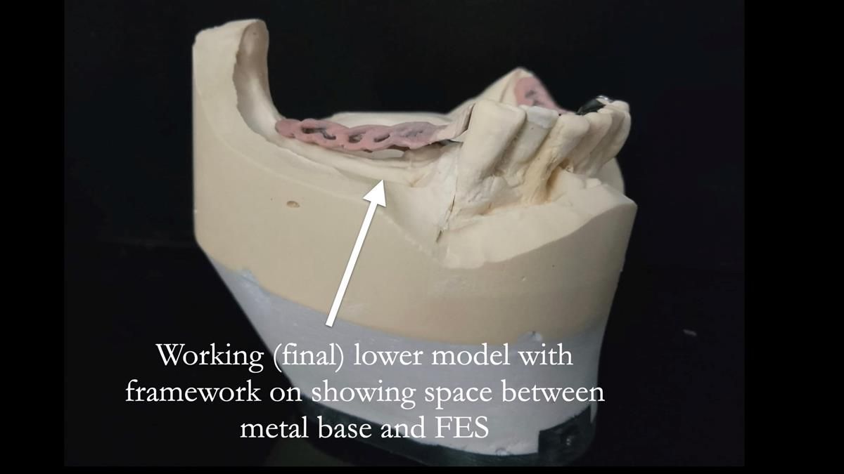 Newsletter 87 – Father Peter: A Partial Denture that needed Minor Miracle