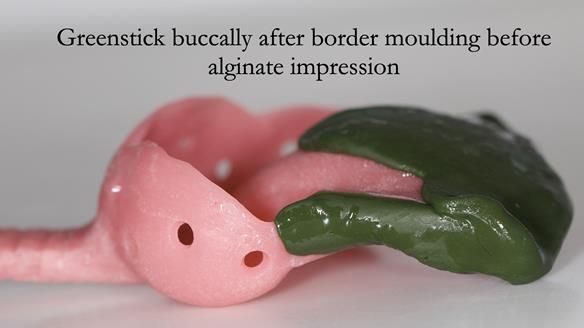 Solving Sue's failed implants with metal based RPD - full protocol Newsletter 43