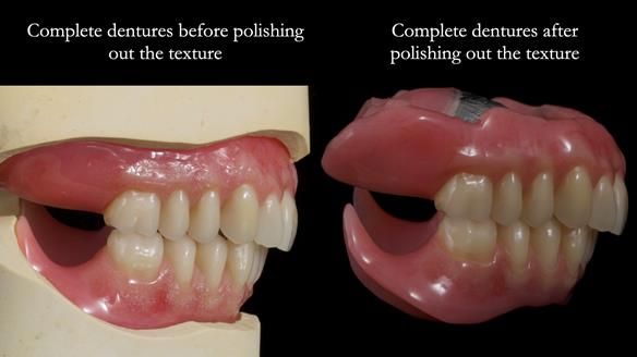 Newsletter 78: What do Clark Gable and a Locator® overdenture have in common?