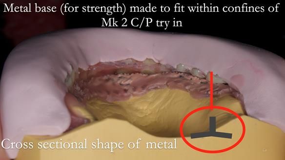 Newsletter 52 Managing Jo’s failing dentition with extractions and Mk 1/Mk 2 complete upper dentures and lower partial dentures FULL PROTOCOL