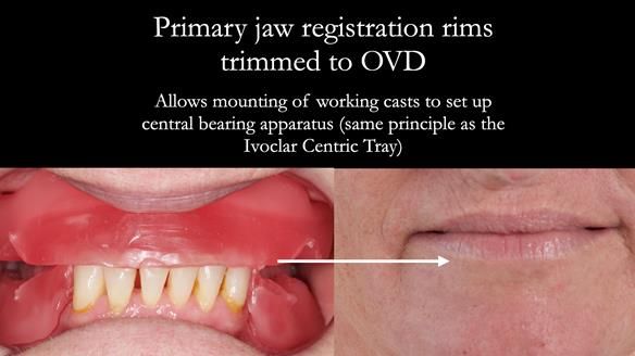Newsletter 52 Managing Jo’s failing dentition with extractions and Mk 1/Mk 2 complete upper dentures and lower partial dentures FULL PROTOCOL