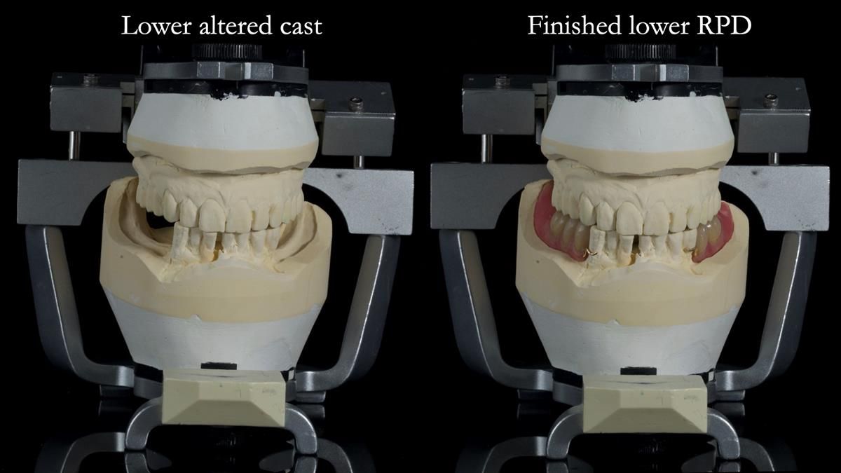 Newsletter 87 – Father Peter: A Partial Denture that needed Minor Miracle